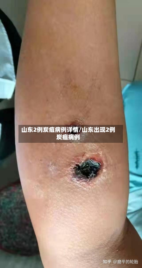 山东2例炭疽病例详情/山东出现2例炭疽病例-第3张图片